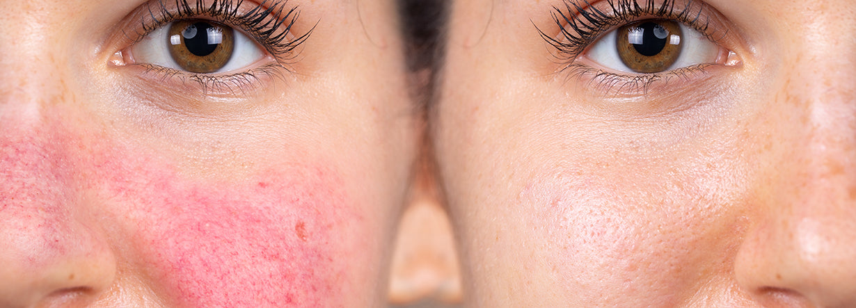 Couperosa-ihon hoito