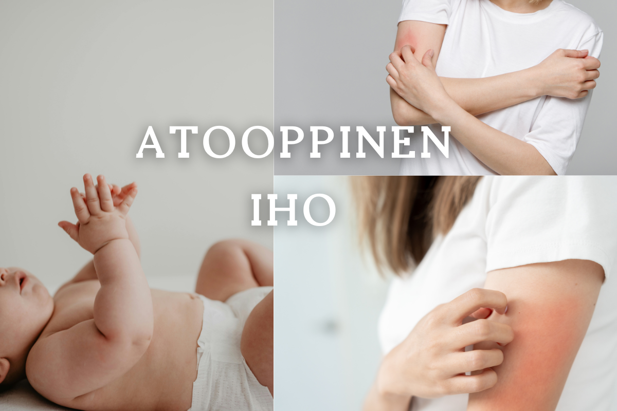 Atooppisen ihon hoito - helpotusta kutisevalle ja ärtyneelle iholle